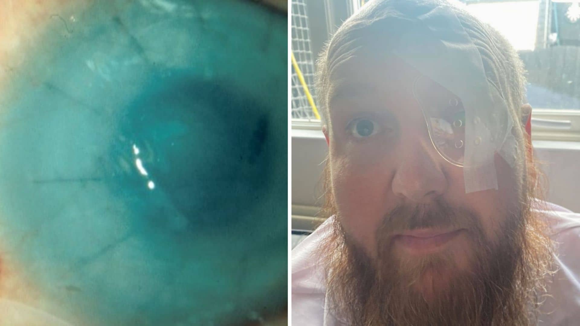 Acid attack victim reveals how donated placenta saved his eye