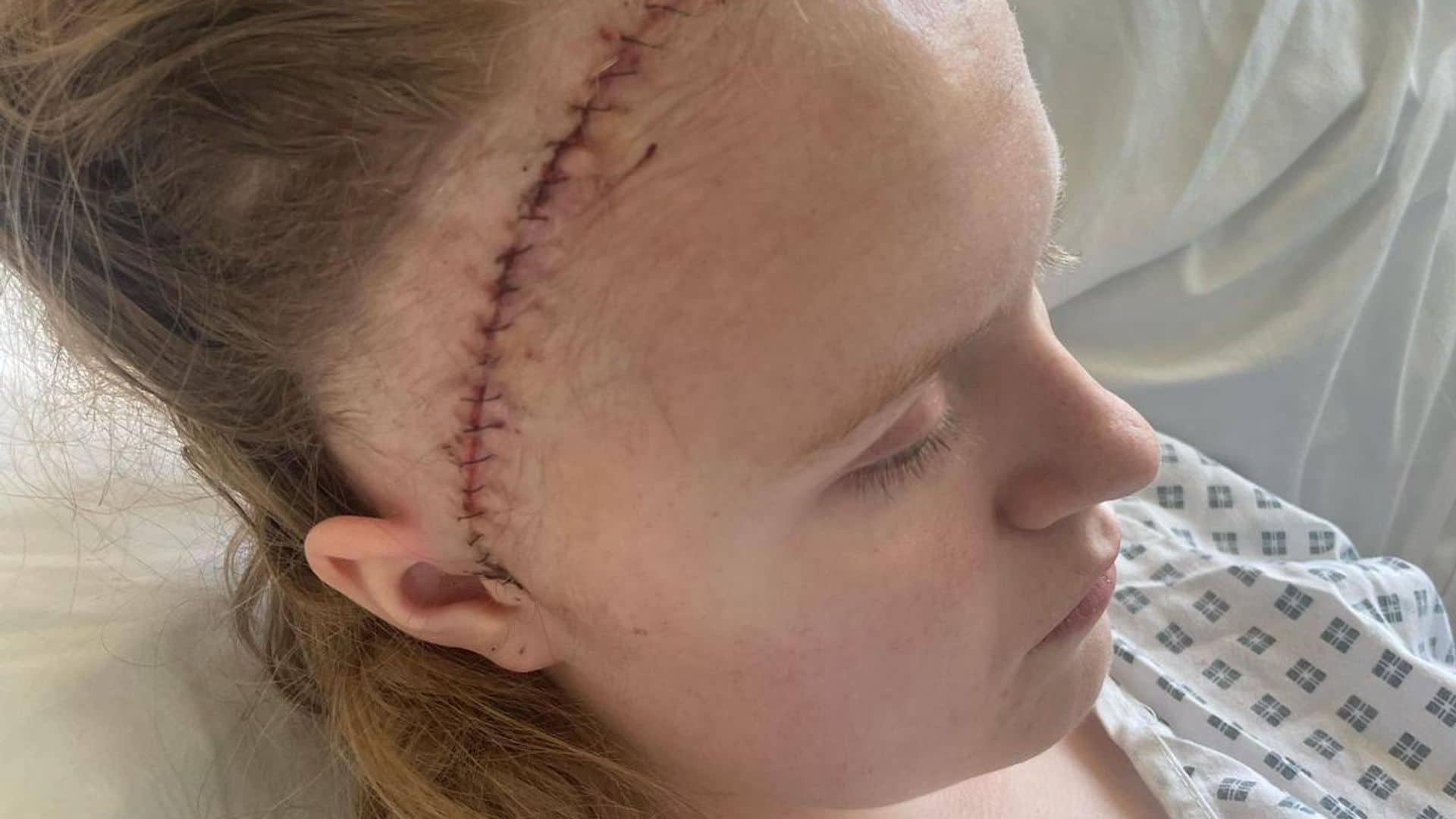 Girl who thought she had sickness bug ended up with part of skull in stomach