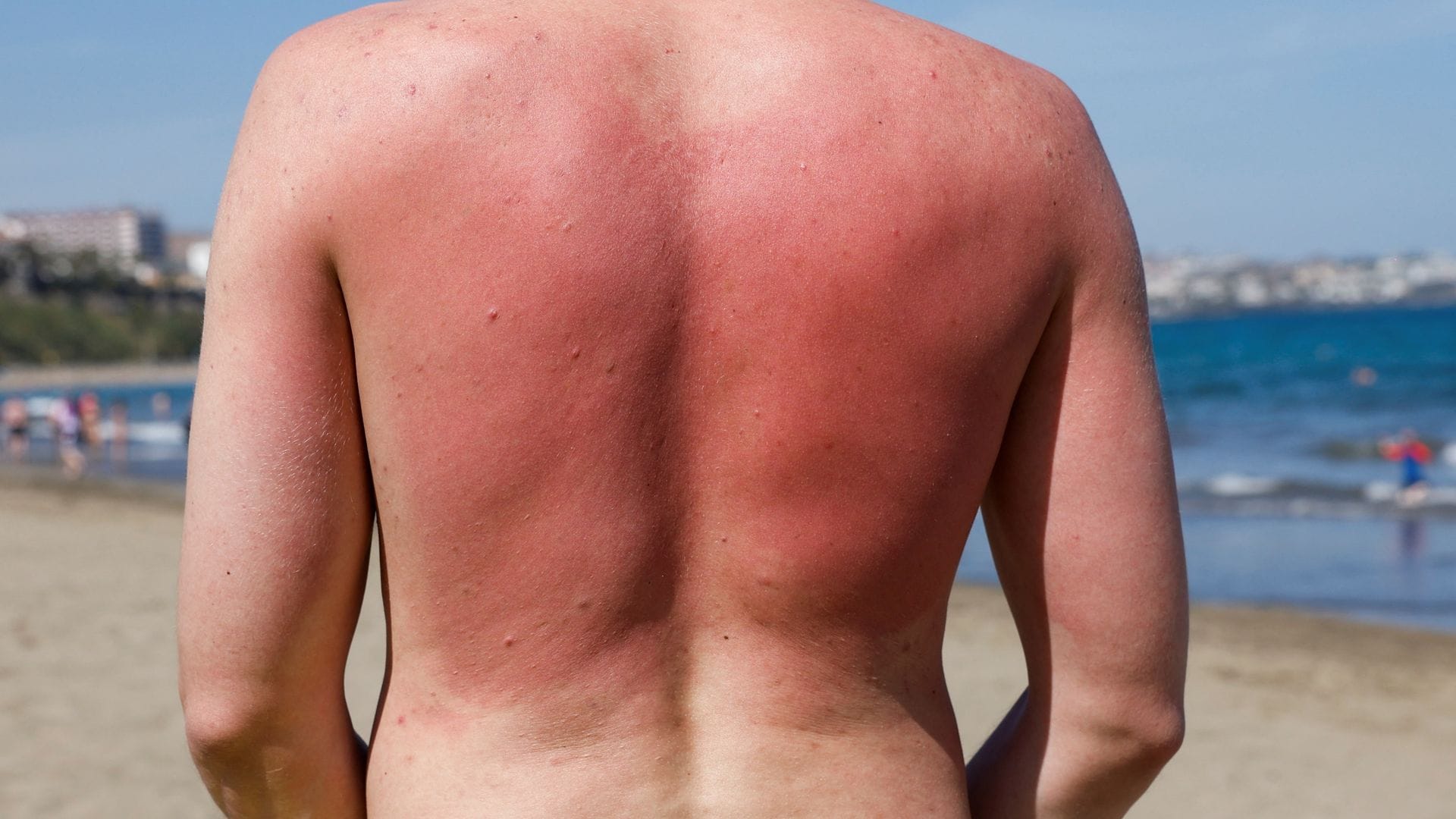 The ‘most effective’ protection to avoid sunburn (and it isn’t suncream)